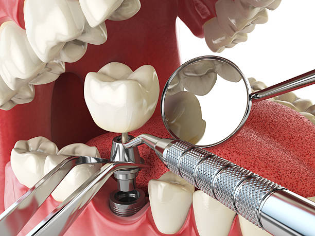 Best Emergency Denture Repair in Lacey, WA